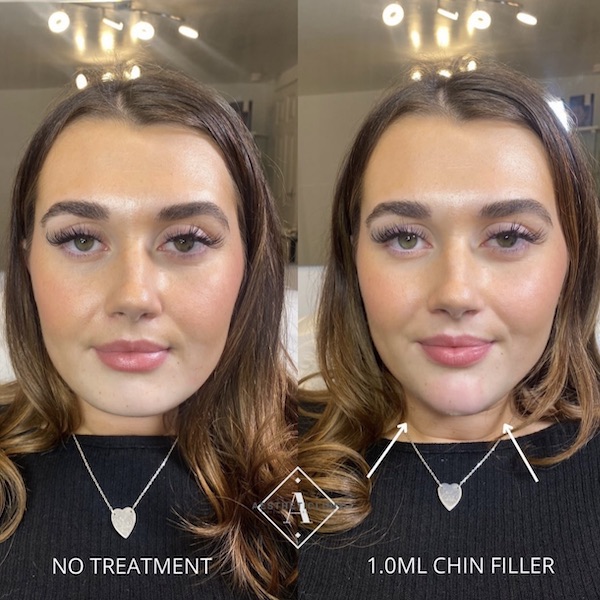 Chin filler before and after Aestheticlinix in Wigan